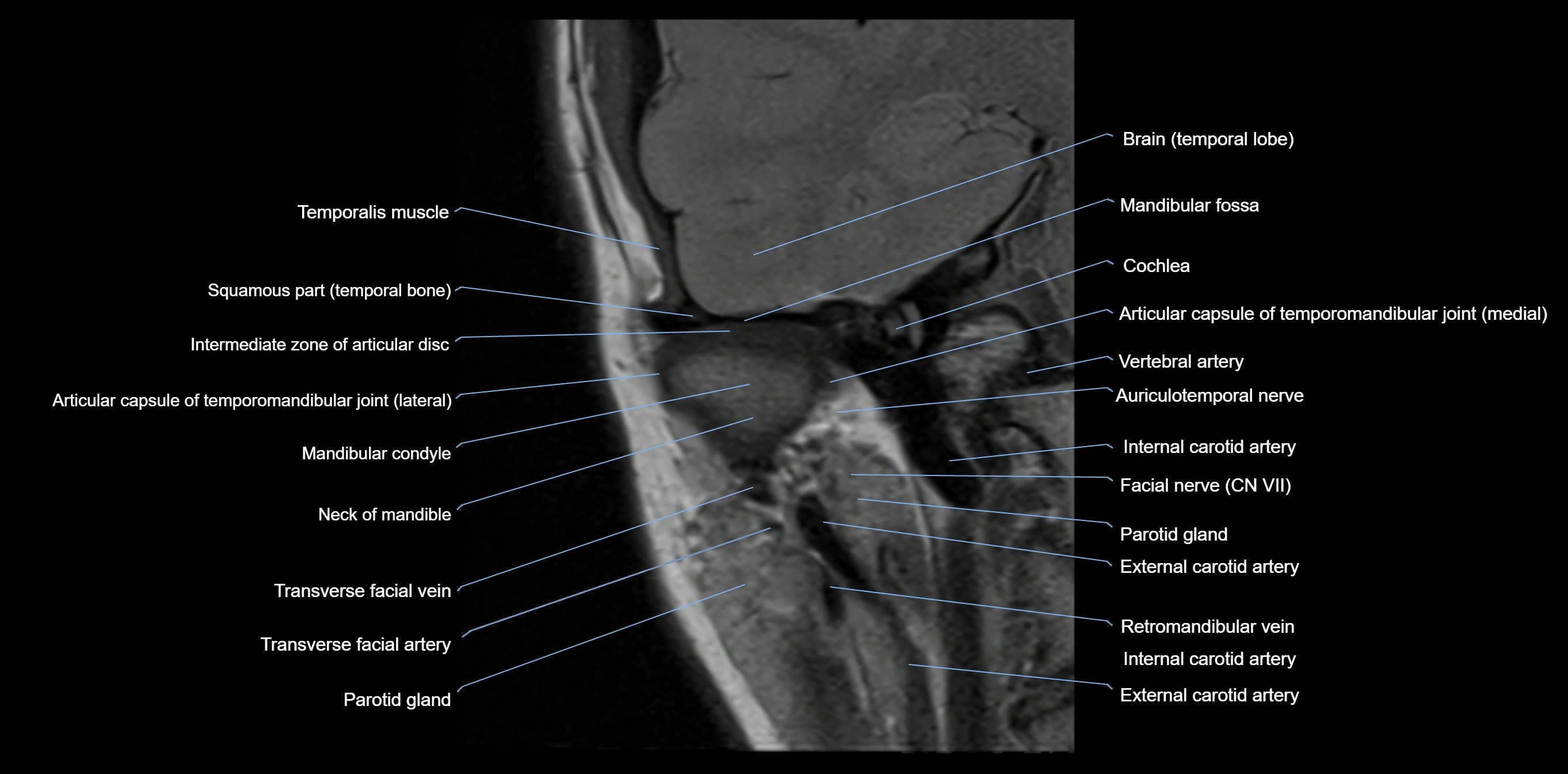 MRI TMJ coronal cross sectional 3T anatomy -img-00004-00008.webp
